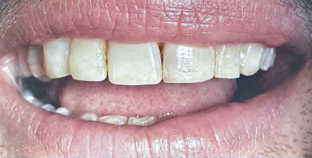 Direct veneers before treatment